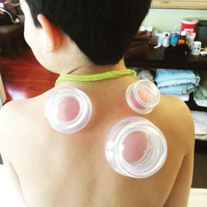 Cupping