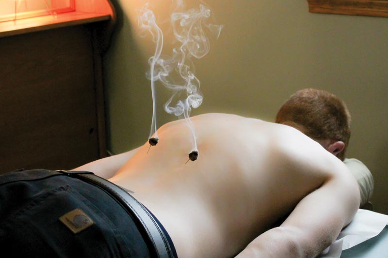 Moxibustion Relieves Pain Reduces Inflammation and Supports the Immune System